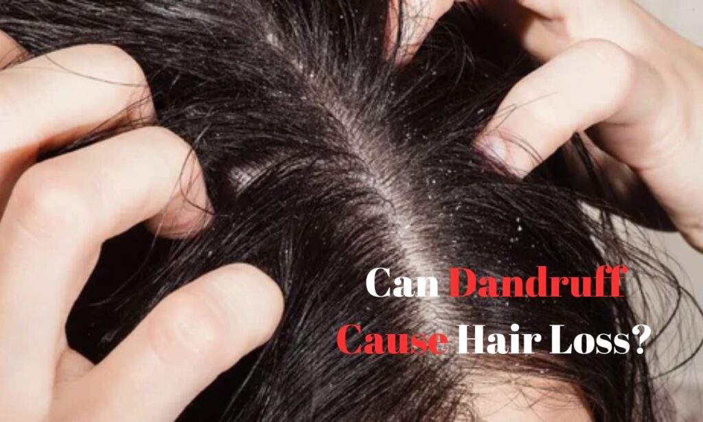 Can Dandruff Cause Hair Loss? Causes, Myths, and Effective