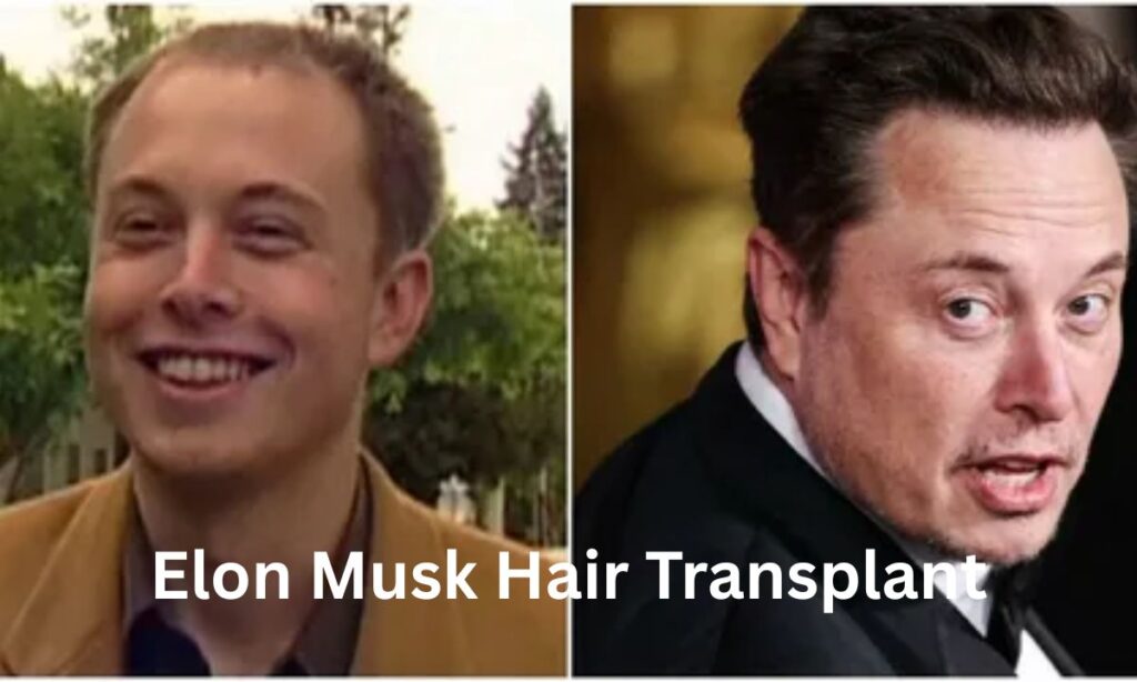 Elon Musk Hair Transplant: Timeline, Cost & Results (2026)