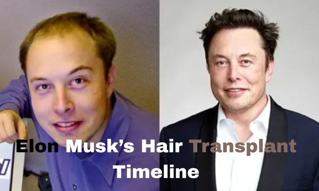 Elon Musk’s Hair Transplant Timeline