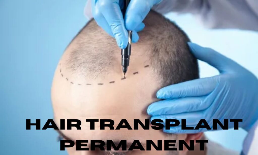 Hair Transplant Permanent: Everything You Need to Know
