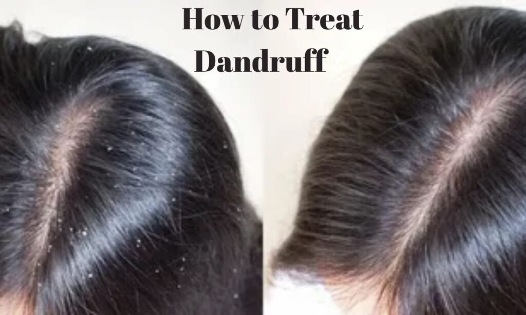 How to Treat Dandruff and Prevent Hair Loss