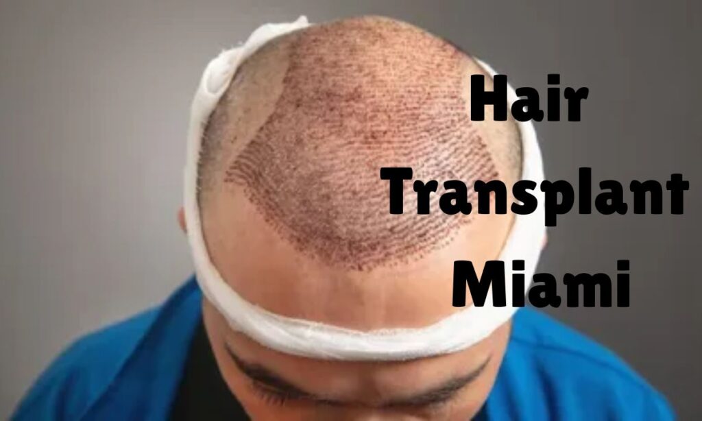 Hair Transplant Miami: Cost, Results & Best Clinics Guide