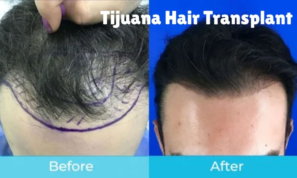 Tijuana Hair Transplant: Cost, Results & Clinics Guide